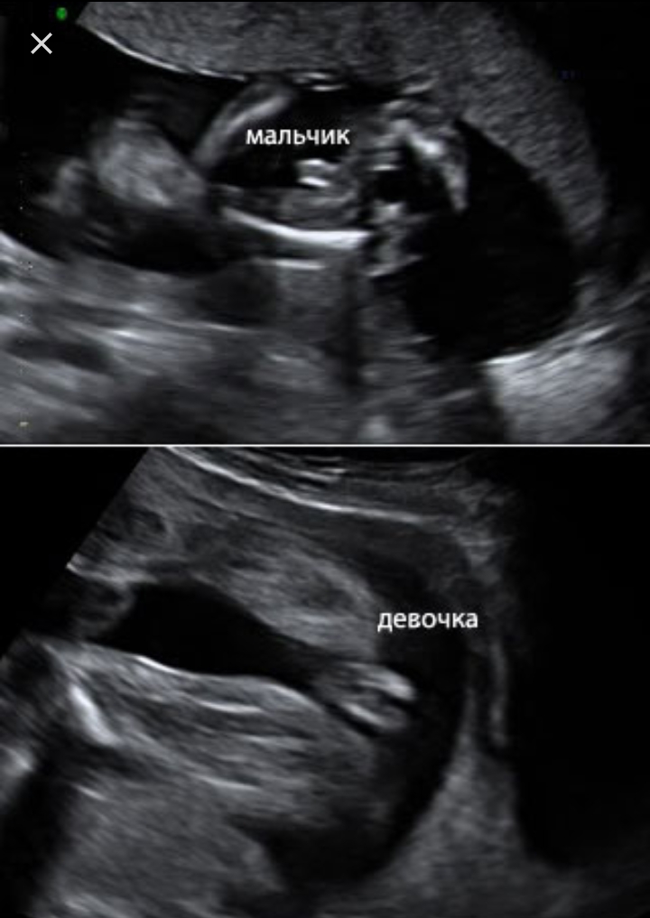 Узи 12 недель беременности мальчик отличие фото