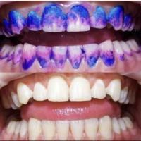 Гигиена 🦷Профилактика