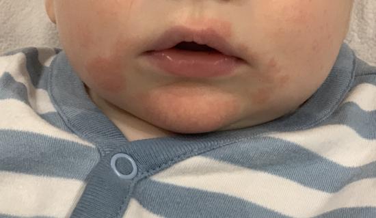 Девочки, help! Вот такая аллергия