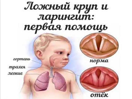 ЛОЖНЫЙ КРУП у детей. Много информации