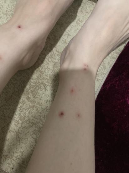 Девочки, меня каждую ночь кусают,