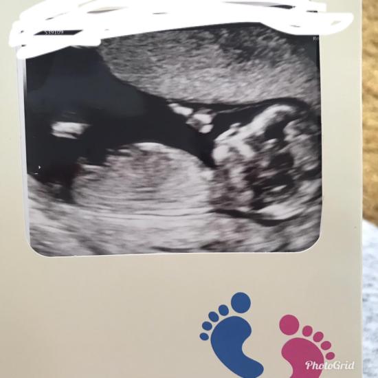 Boy or girl what you think 13 weeks