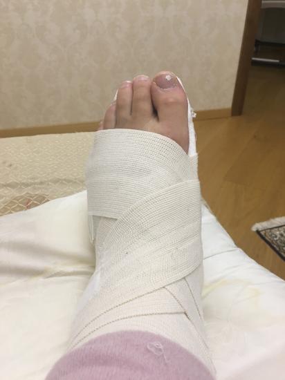 Девочки, 😭😭😭 я сломала пятую плюсневую